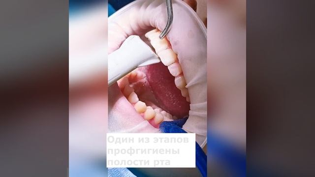 Air Flow — этап профгигиены полости рта. Удаляем биопленку
