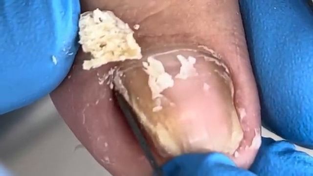 ?Broken toenails that were wrongly trimmed, re treated【Xue Yidao】 смотреть онлайн