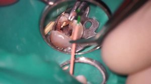 Лечение под микроскопом