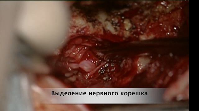 Микрохирургическое удаление фораминальной поясничной грыжи диска из латерального доступа смотреть онлайн
