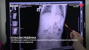 Ноябрьские врачи спасли двухлетнего ребёнка, который проглотил  17 магнитных шариков