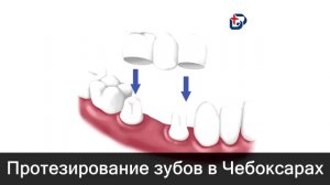 Протезирование зубов в Чебоксарах