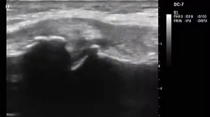 Повреждение медиального мениска на фоне выраженных дегенеративных изменений.