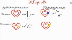 ИНФАРКТ МИОКАРДА | разбор ЭКГ