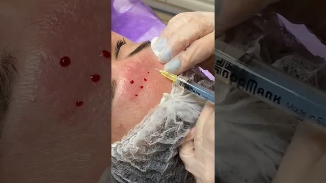 Мезотерапия лица смотреть онлайн