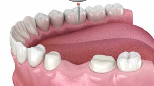 Удаление амальгамы и подготовка к установке керамического моста
