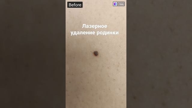 Удаление родинки (невуса) лазером | Laser removal of a nevus