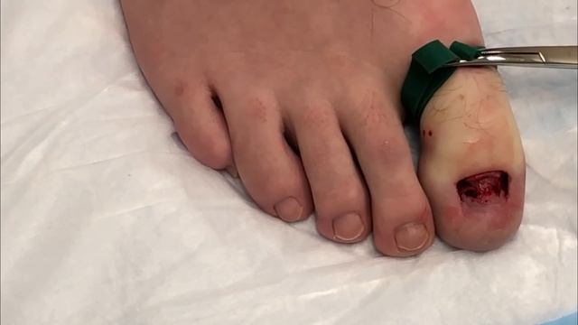 Double Trouble Toenail Removal - Onychomycosis and Onychogryphosis смотреть онлайн