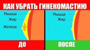 Гинекомастия у Мужчин. Как Избавиться Без Операции. Гина