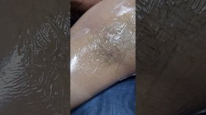 аппликационная анестезия для электроэпиляции