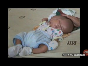 ШОК. У РЕБЕНКА 2 ЛИЦА и 2 МОЗГА. В ИНДОНЕЗИИ РОДИЛСЯ  МАЛЬЧИК с ДВУМЯ ЛИЦАМИ. СЕНСАЦИЯ в МЕДИЦИНЕ.