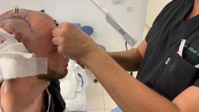 hair transplant in Bellus clinic / пересадка волос в Bellus Clinic смотреть онлайн