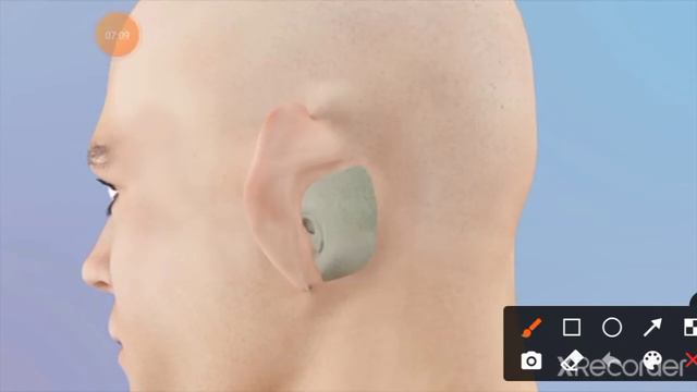 Chronic Suppurative Otitis Media 3| Atticoantral Type смотреть онлайн