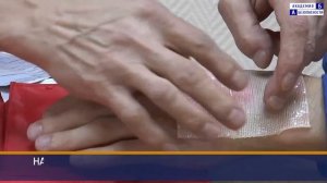 Местное охлаждение и наложение первичной повязки при термических ожогах с помощью комплекта Апполо