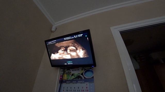 УЗИ по ОПРЕДЕЛЕНИЮ ПОЛА РЕБЕНКА! смотреть онлайн