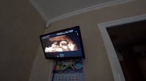 УЗИ по ОПРЕДЕЛЕНИЮ ПОЛА РЕБЕНКА!