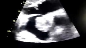 Myxoma in left atrium - SubCostal View TTE