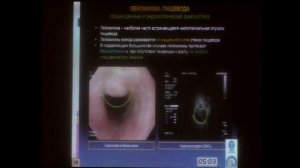 09 Сухин ДГ Полиповидные образования пищевода Эндоскопическая симеотика
