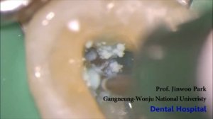 Индикатор канальных отверстий Canal-Seek