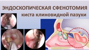 Эндоскопическая сфенотомия (сфеноидотомия). Лор-хирургия: удаление кисты клиновидной пазухи.