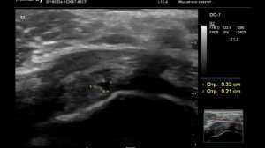 Двойной разрыв бицепса