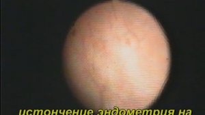 Фемостон. Тонкий эндометрий при гистероскопии