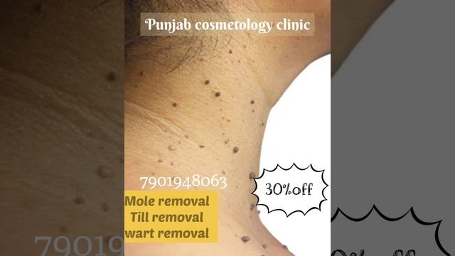 Mole Removel  Wart Removel Skin Specialist Punjab Cosmetology Clinic  Banga Road Nawanshar