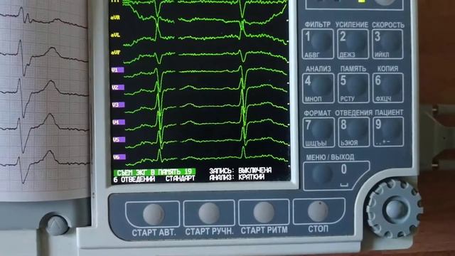 Электрокардиограф ЭК12Т-01-"Р-Д" с экраном 141мм модель G0500 с автоматическим заключением смотреть онлайн