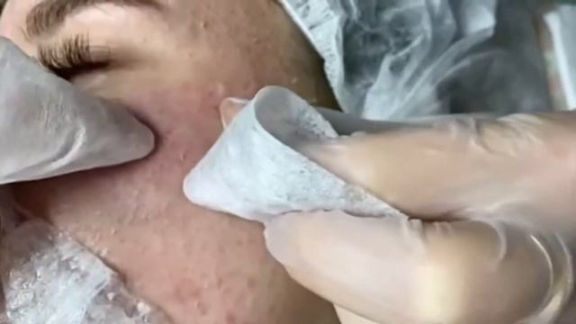 НОВОЕ. Чистка лица от черных точек.