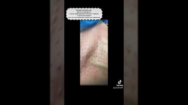 Мезо #аёллар #tashkent #косметолог#фойдали #тошкент #uzbekistan #интересно #turkey #мезотерапия смотреть онлайн