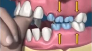 последствия сосания пальца