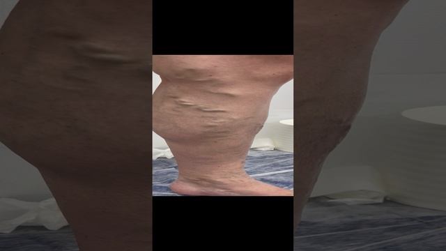 Запись на прием к флебологу в Москву, пишите в вацап 89250423646. Флеболог Москва. Лечение варикоза смотреть онлайн