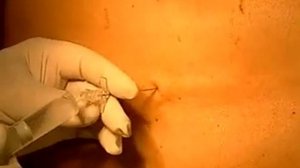 Постановка эпидурального катетера