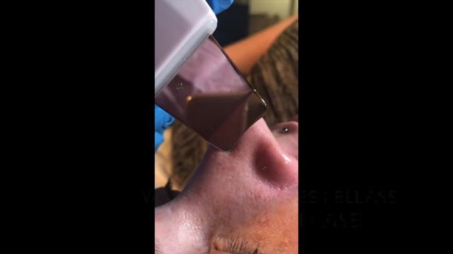 ULTRASONIC SKIN SCRUBBER EXTRACTIONS смотреть онлайн