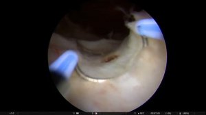 submucosal myomectomy#hysteroscopy #гистероскопия #удаление узлов#