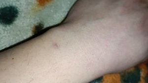 Рубец после удаление родинки спустя пол года
