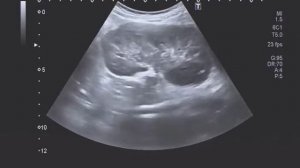 Нефросклероз справа