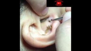Очистка угрей, которые стали черными и большими | blackhead in ear 2018