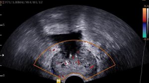 ТРУЗИ режим цветного допплеровского картирования