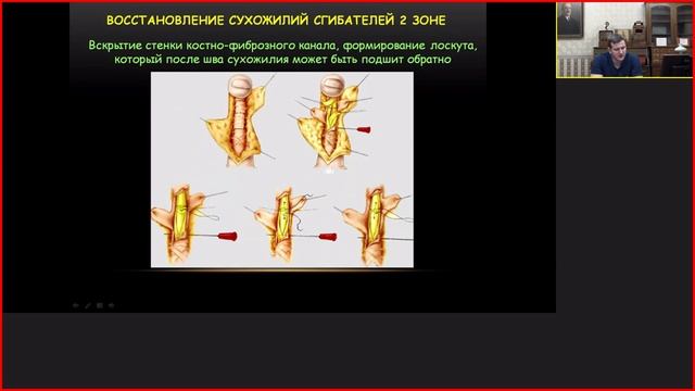 Повреждение сухожилий сгибателей.