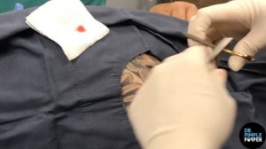 The Hidden Volcano Cyst