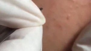 loan nguyen acne removal