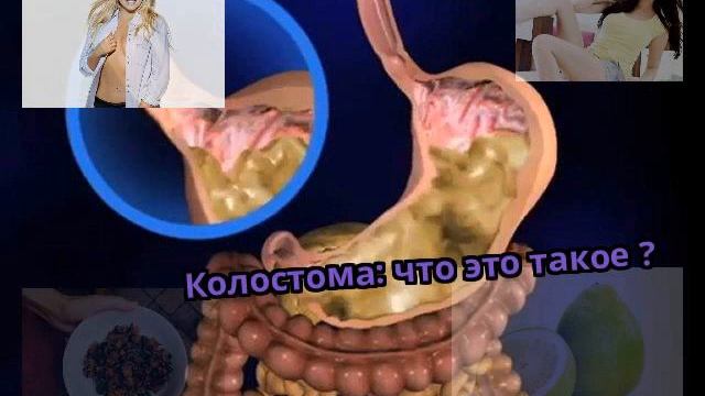 Колостома: что это такое ?