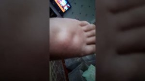 Продолжение, перелом лодыжки.