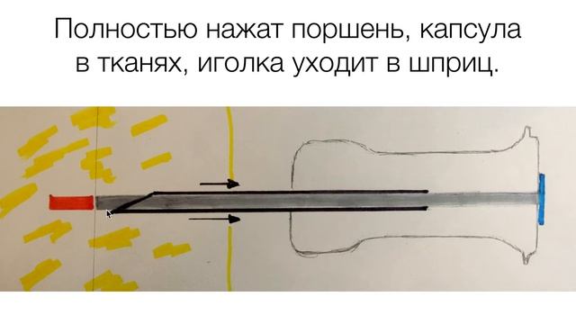Золадекс. Зашла ли капсула?