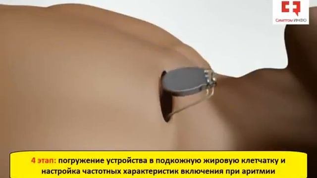 Установка кардиостимулятора_ показания, этапы операции и принцип лечения аритмии сердца