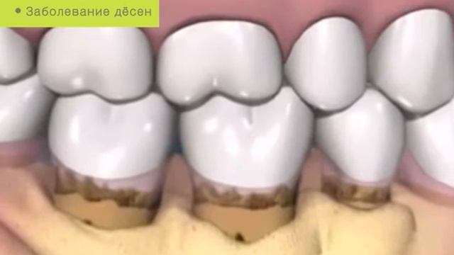 Школа здоровья. Какие бывают заболевания дёсен смотреть онлайн