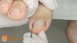 Hallux cleaning | 6-month follow-up | 2nd video #podologiaintegral