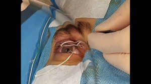 Ревизионная реконструктивная хирургия птоза верхнего века