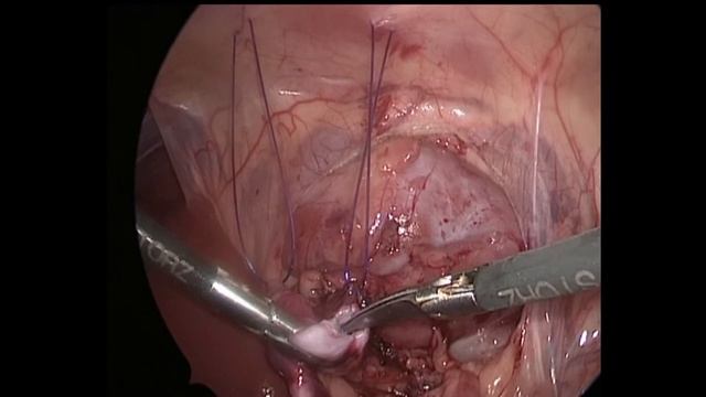 Гидронефроз